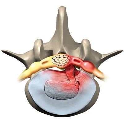 sciatica